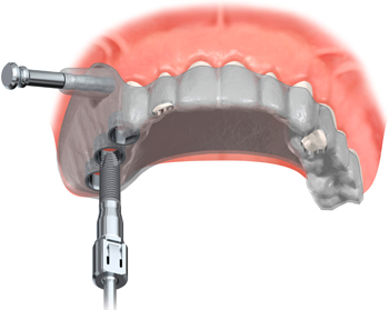 安全性・確実性の向上のためにガイデッドサージェリー