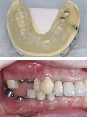 サージカルガイドによるガイデッドサージェリー手術
