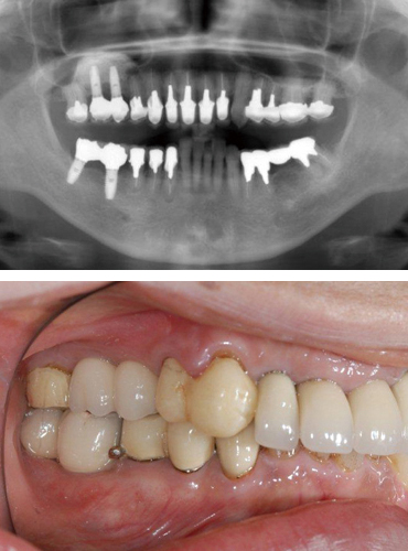 インプラント手術後
