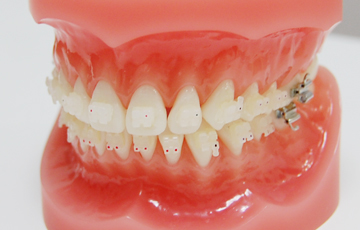 セラミックブラケット