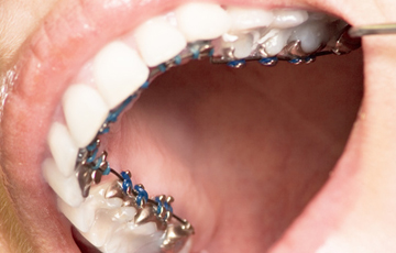 リンガル矯正・裏側舌側矯正