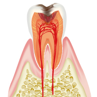 虫歯進行度C3