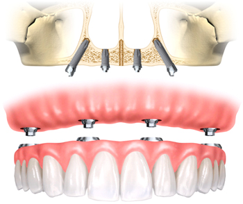 総入れ歯に変わり即日に噛めるオールオンフォー術式