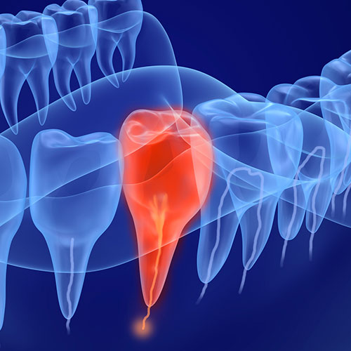 歯を残す根管治療